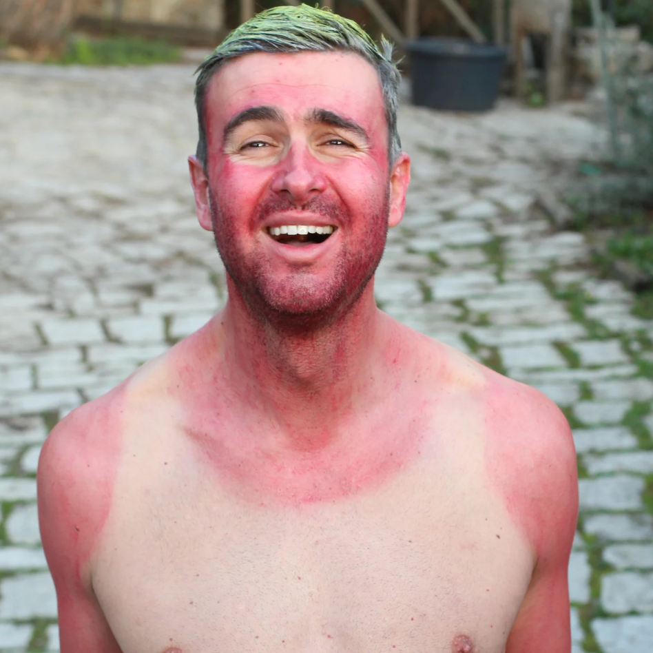 Sun Exposure and Eczema: UV as a Trigger and How to Protect Your Skin