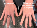 Before Porphose eczema treatment - active eczema symptoms on skin