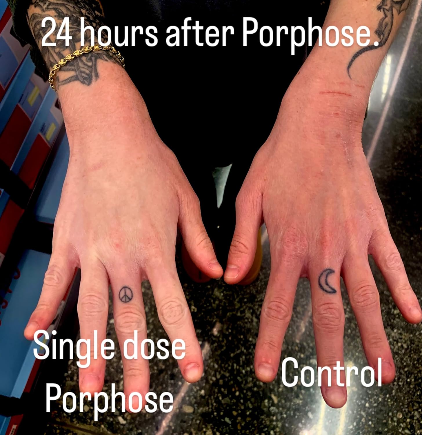 Porphose Eczema Relief
