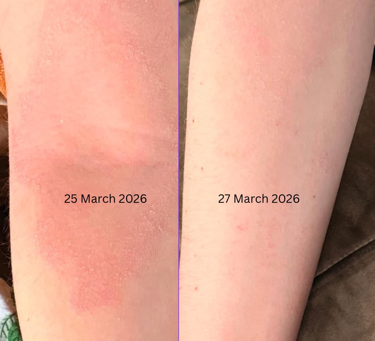 Eczema treatment results on forearm after Porphose - near complete resolution