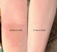 Eczema treatment results on forearm after Porphose - near complete resolution