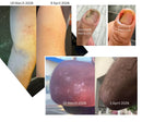 Porphose eczema relief results across multiple body areas