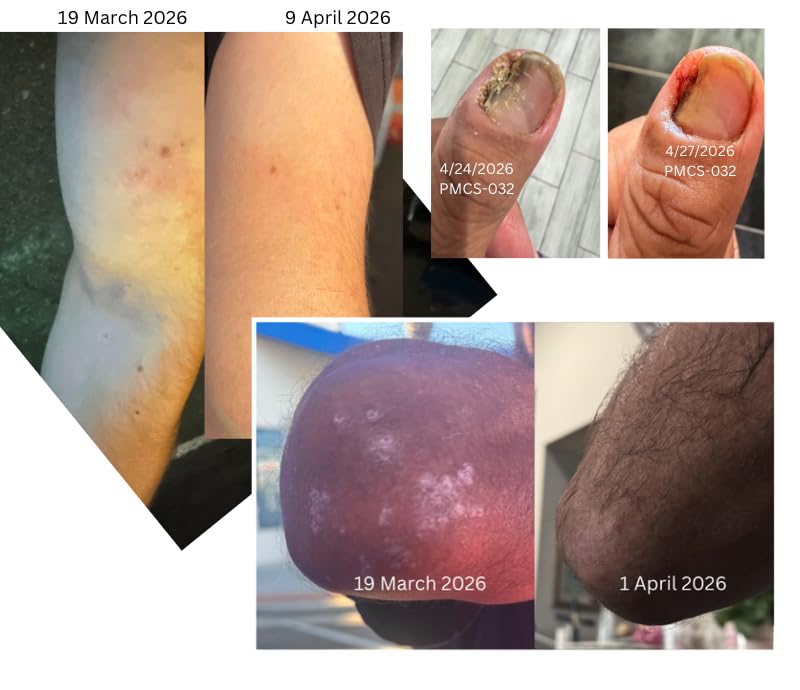 Porphose eczema relief results across multiple body areas
